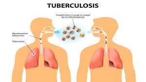 80 percent of Tuberculosis cases in Nigeria undiagnosed- Minister