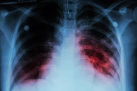 Prevent future pandemics by tackling tuberculosis (TB), finds new report