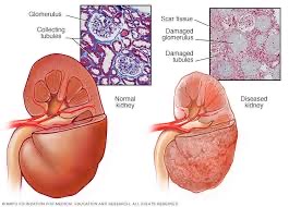 Chronic kidney disease: Africa’s silent killer